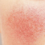 Acne Rosacea - Fighting with rosacea