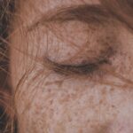 Remove Freckles - Getting rid of freckles