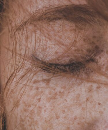 Remove Freckles - Getting rid of freckles